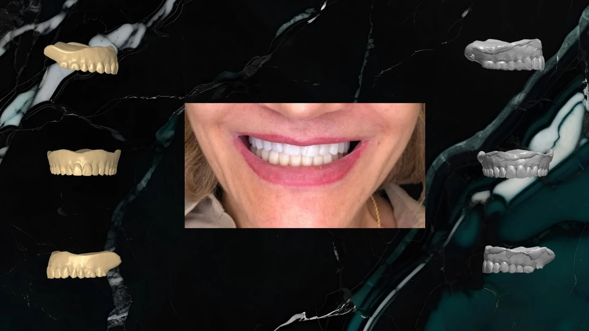 Close-up of a woman’s smiling mouth showing 3d printed  digital denture and floating older dental molds in beige and gray.