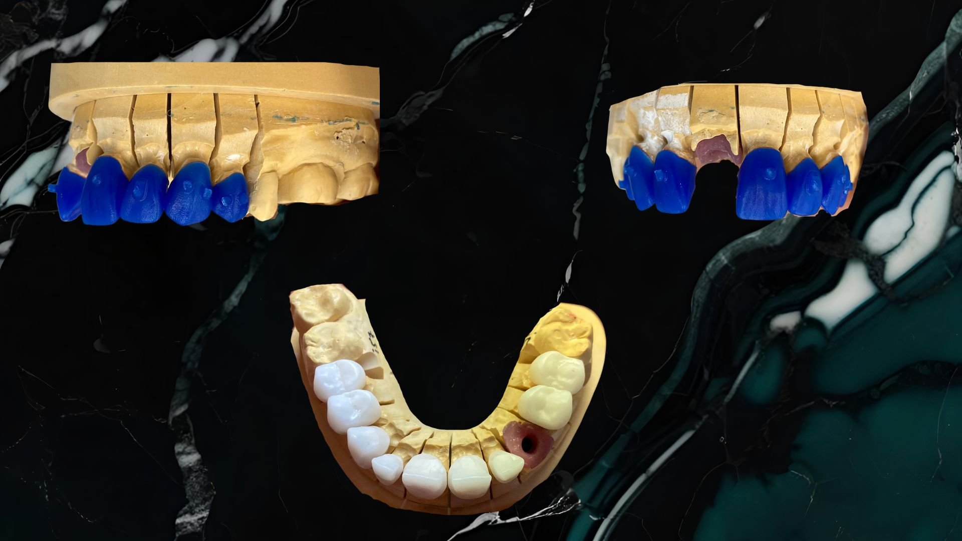 Three dental casts of teeth, one with colored teeth and a crowned tooth, displayed on a dark surface.