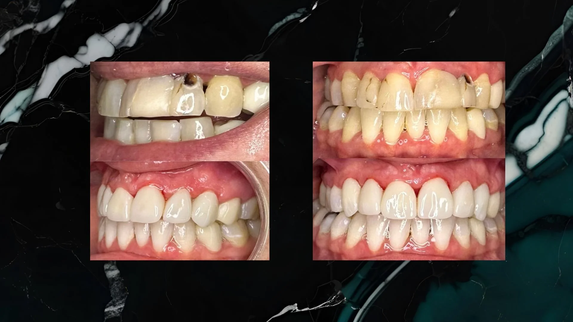 Comparison of teeth before and after dental treatment, showing improved alignment and removal of cavities.