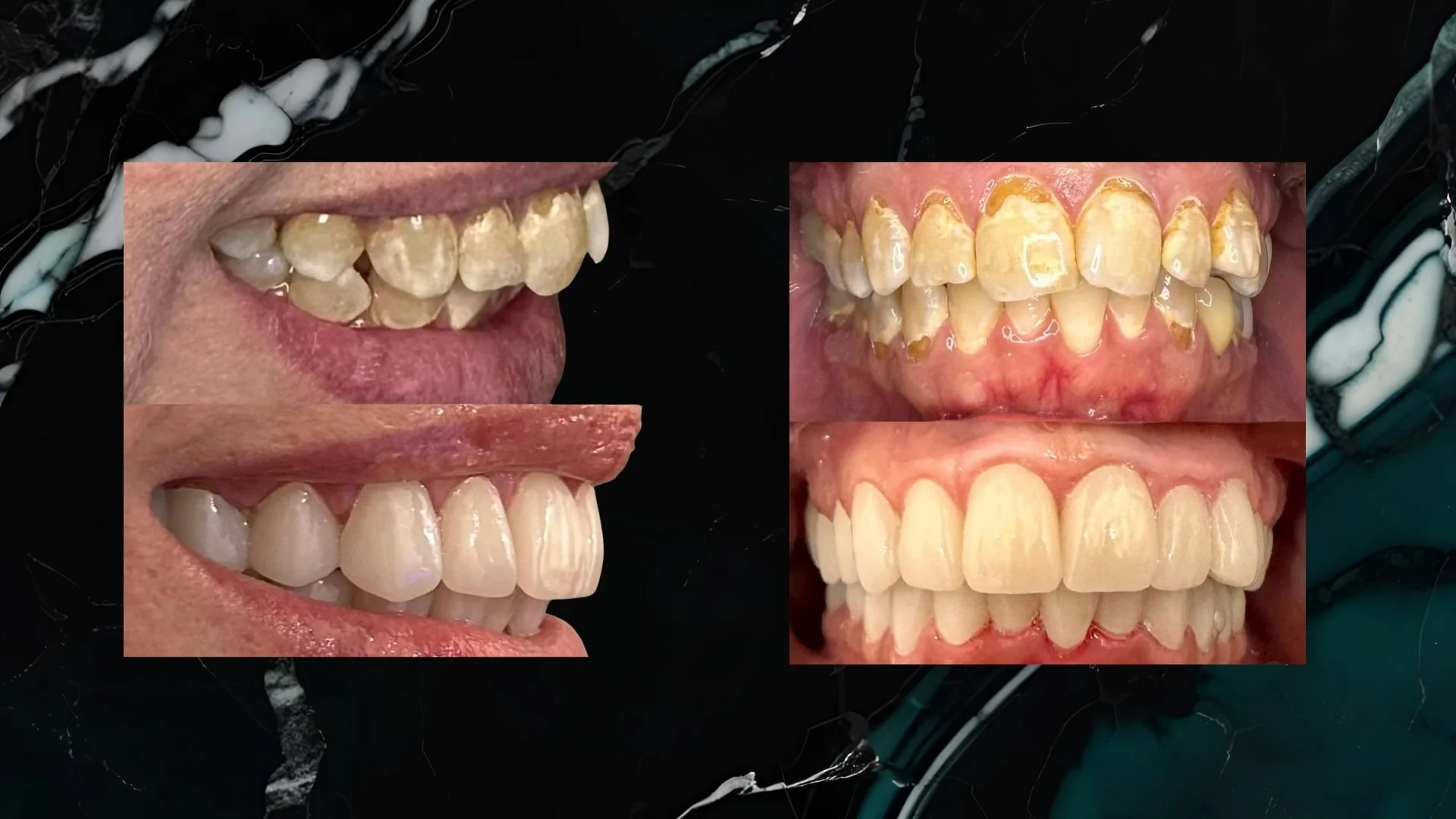 Comparison of teeth before and after dental treatment, showing improved alignment and appearance.