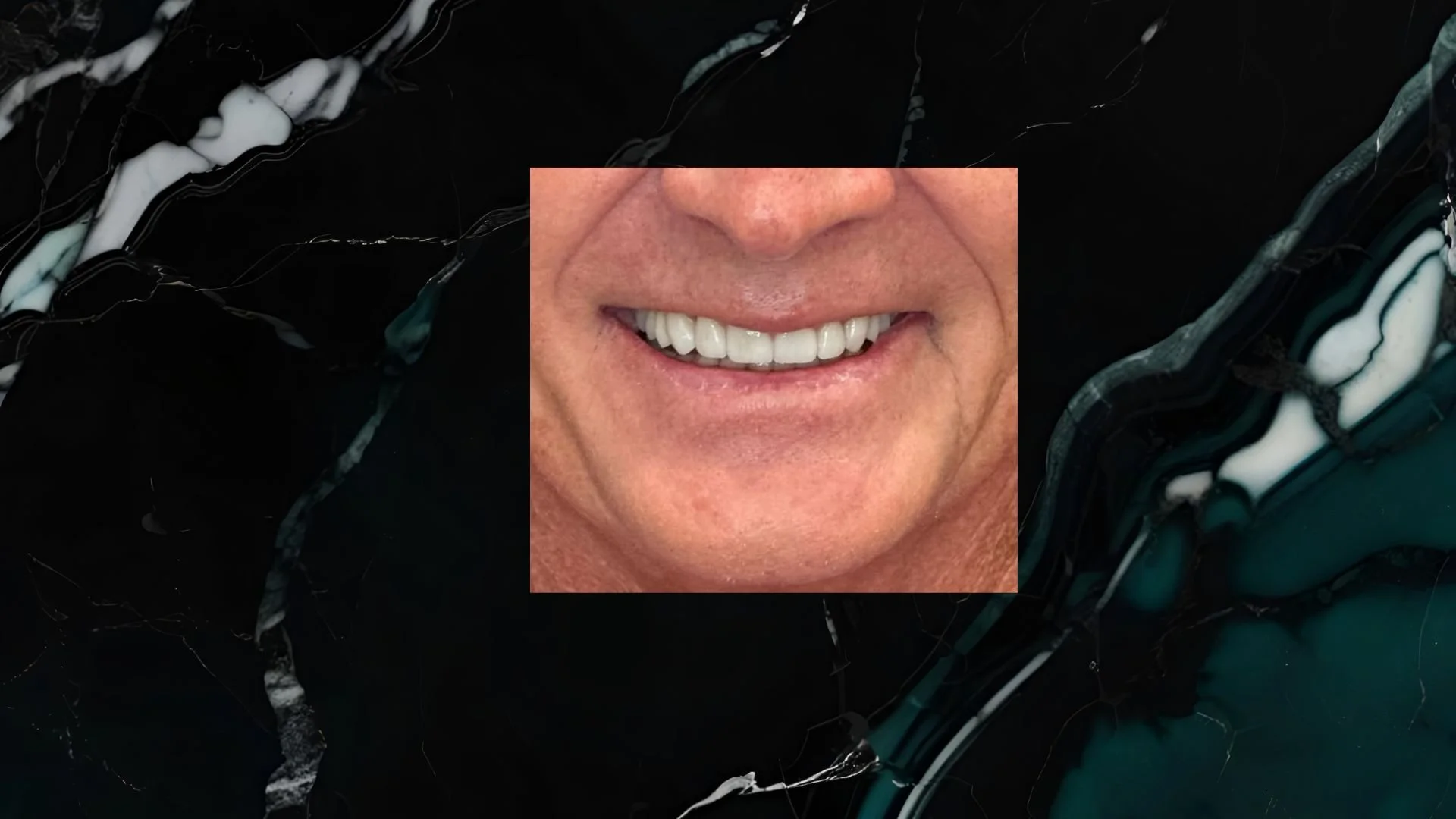 Close-up of a smiling person's mouth showing white teeth and  new smile  