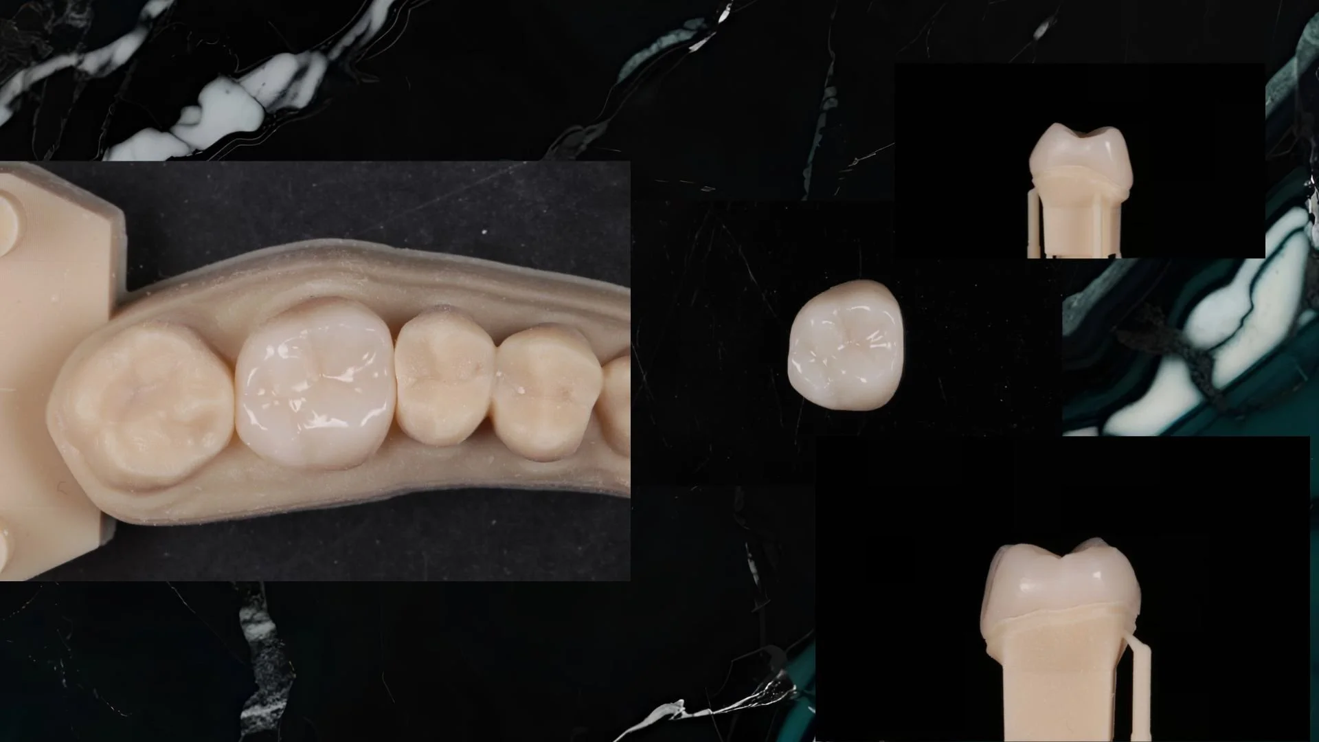 Close-up of a dental model displaying multiple dental crowns and a tooth veneer on a black background.