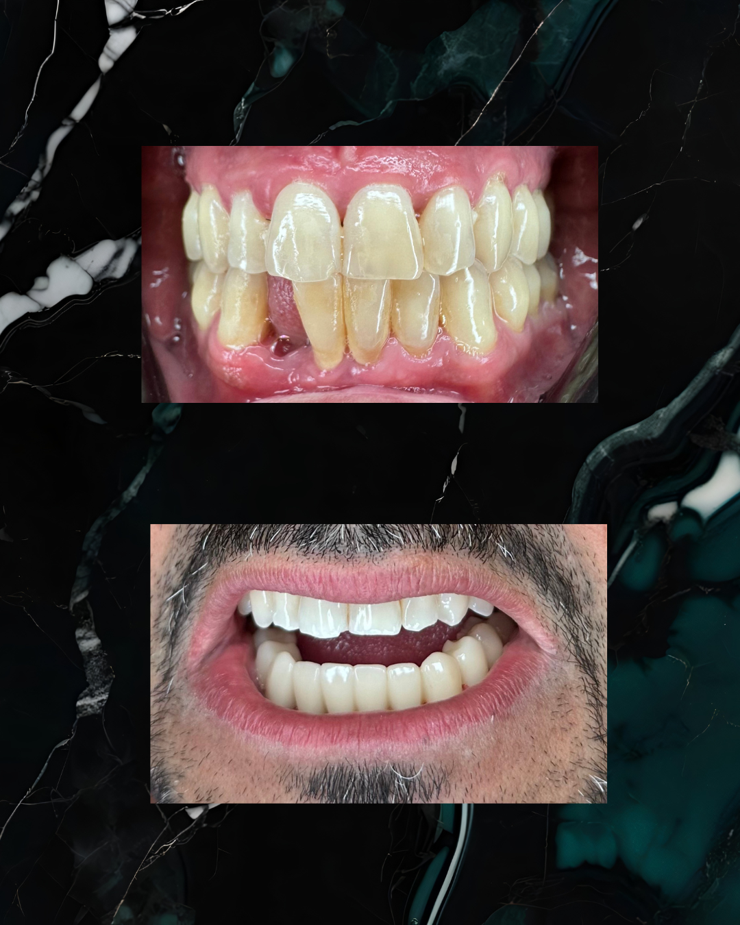 Close-up of a  teeth before and after dental treatment, showing yellowed and stained teeth in the before and new whiter, cleaner teeth dental bridge in the after image.