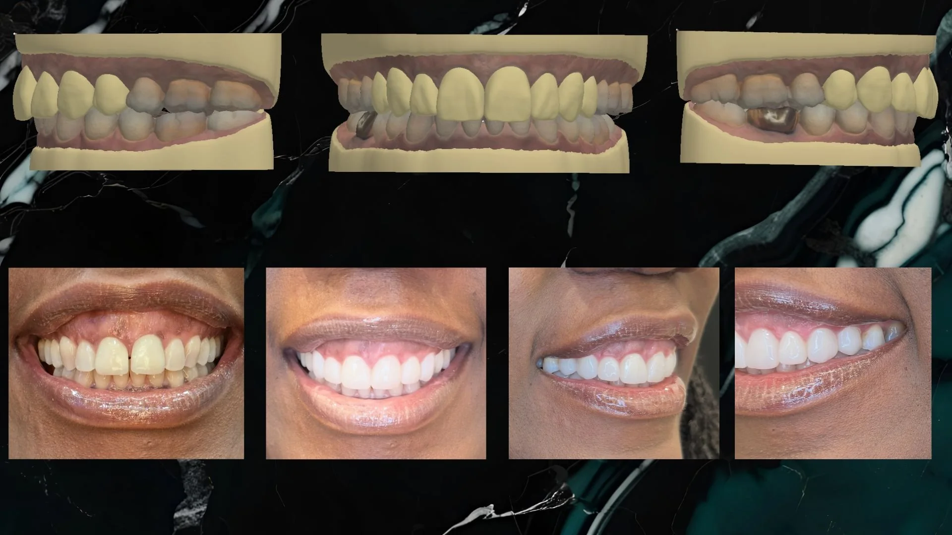 Comparison of teeth before and after dental treatment, including digital models of oral structure and photographs showing improved smile.