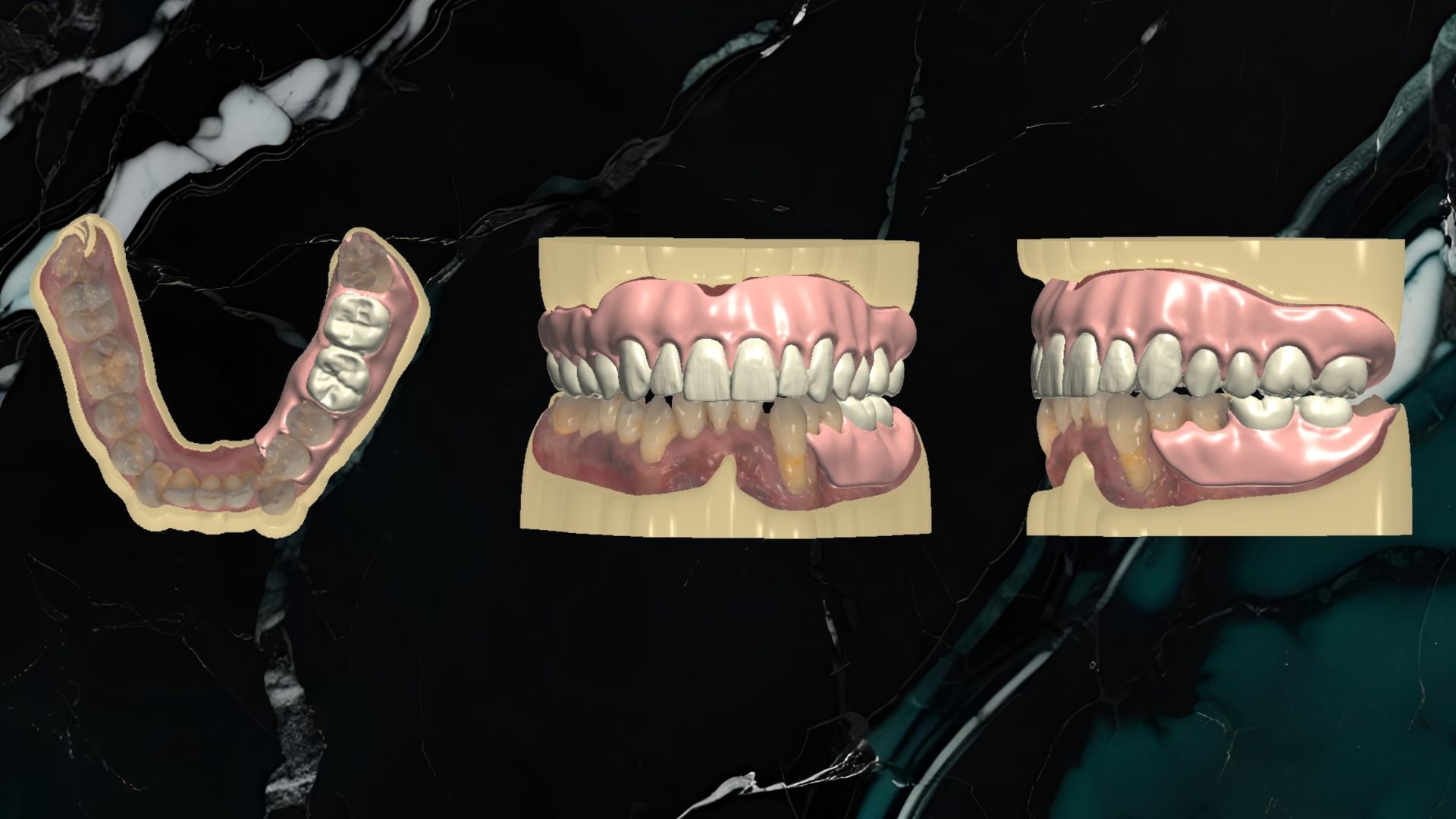 3D digital rendering of a set of upper and lower teeth, a side view of a dental arch, and a close-up of the front teeth and bite alignment.