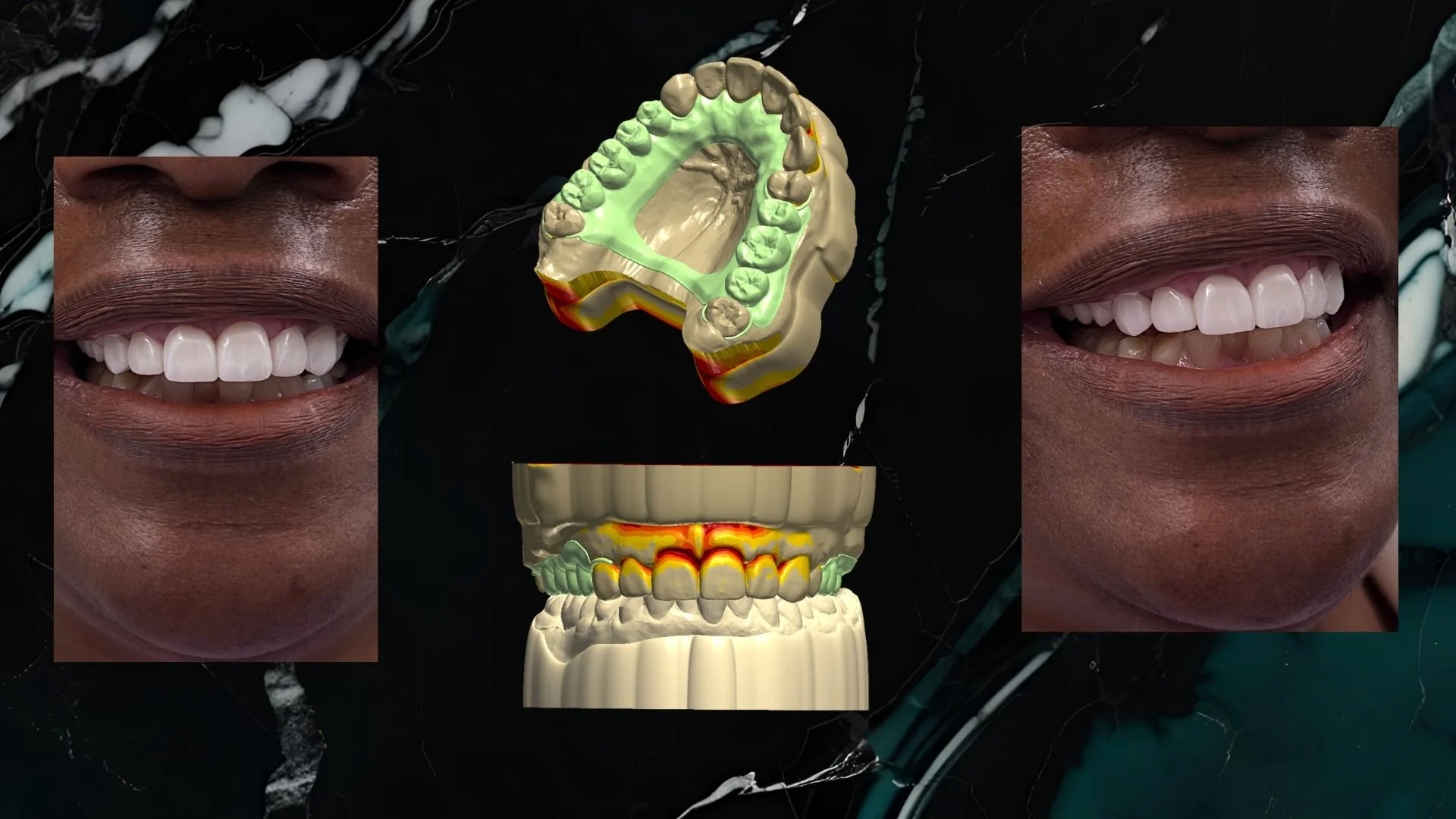 Comparison of a person's teeth before and after dental treatment, with 3D printed removable partial and full contour crowns