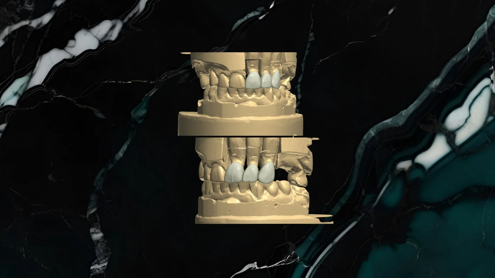 3D digital rendering of a dental model showing upper and lower teeth with some teeth highlighted in white, set against a black marble background.