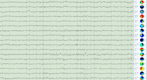 mitsar ICA raw eeg dr ferroly.png