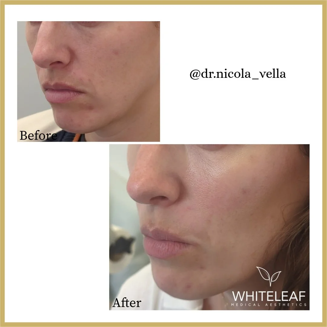Cheek filler — Whiteleaf Medical Aesthetics