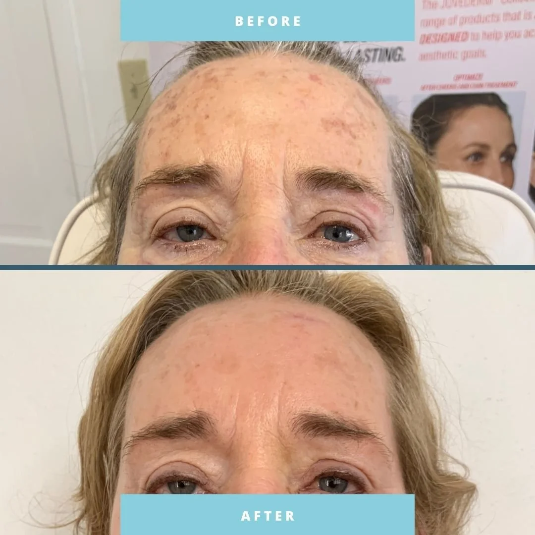 🌟 Goodbye age spots, hello radiance!
Elite MD lasers reduce pigmentation to restore youthful, even-toned skin.
Your glow, customized by a Board-Certified Physician.