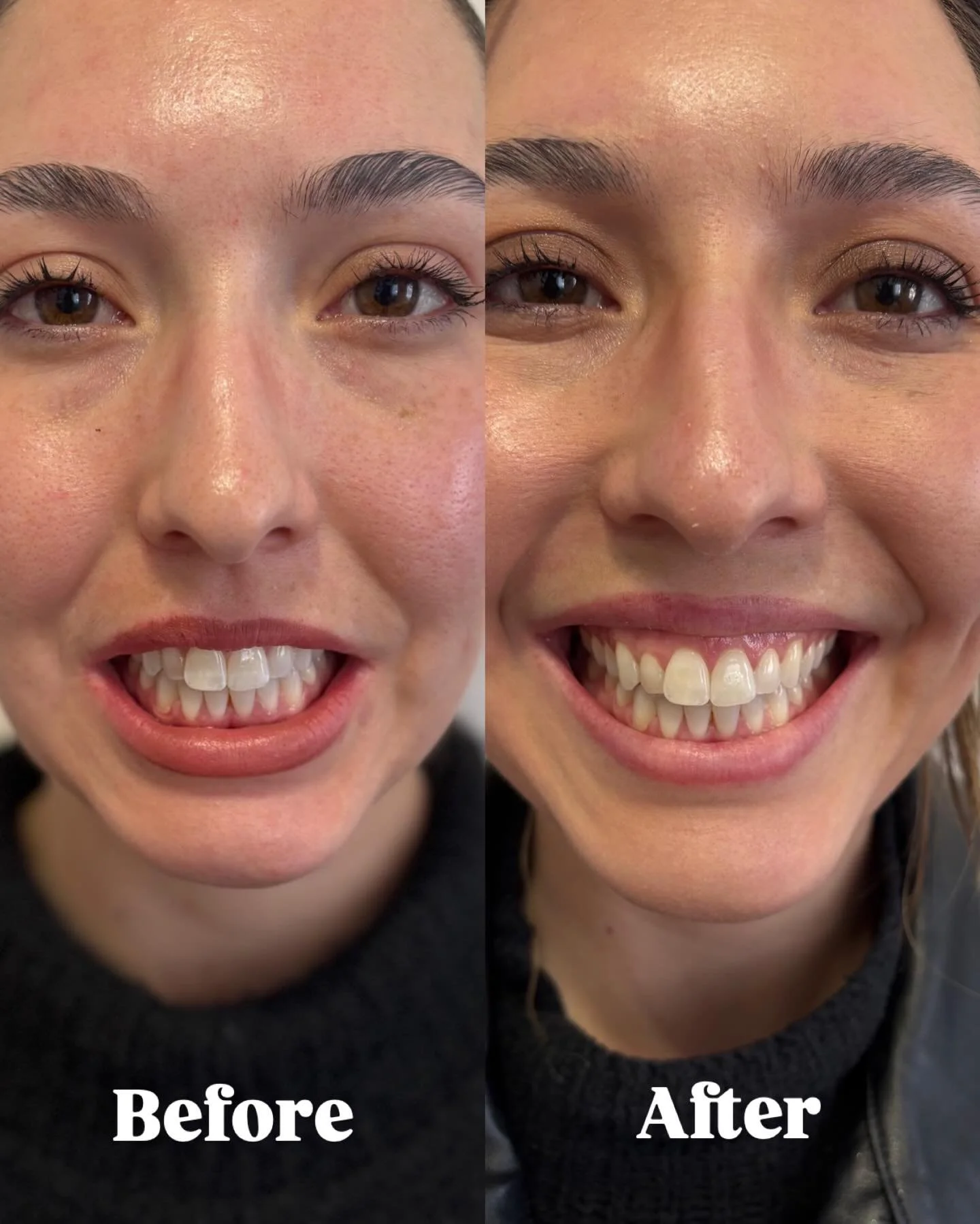 Jaw tension isn&rsquo;t just uncomfortable&mdash;it can change how your face feels and looks.

✨ Masseter Botox helps relax overworked jaw muscles, easing TMJ symptoms like clenching, headaches, and jaw pain&mdash;while also creating a softer, slimme