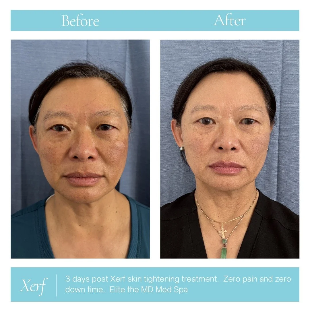 Dr. Lui is 3 days post-XERF&hellip; and already loving the results.

&ldquo;My face feels soooo good! My right droop by the corner of my mouth is almost gone!!!&rdquo;

Tighter. Smoother. Just an overall refreshed feeling.

At Elite MD, we don&rsquo;