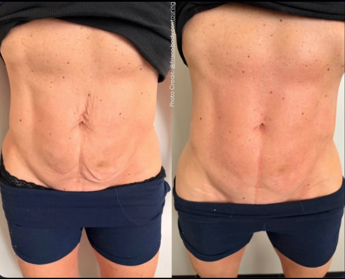 Loose skin after weight loss? We&rsquo;ve got you.

XERF isn&rsquo;t just for the face&mdash;it&rsquo;s a powerful treatment for the body too. Arms, stomach, thighs&hellip; areas where skin doesn&rsquo;t always bounce back the way we want. XERF works