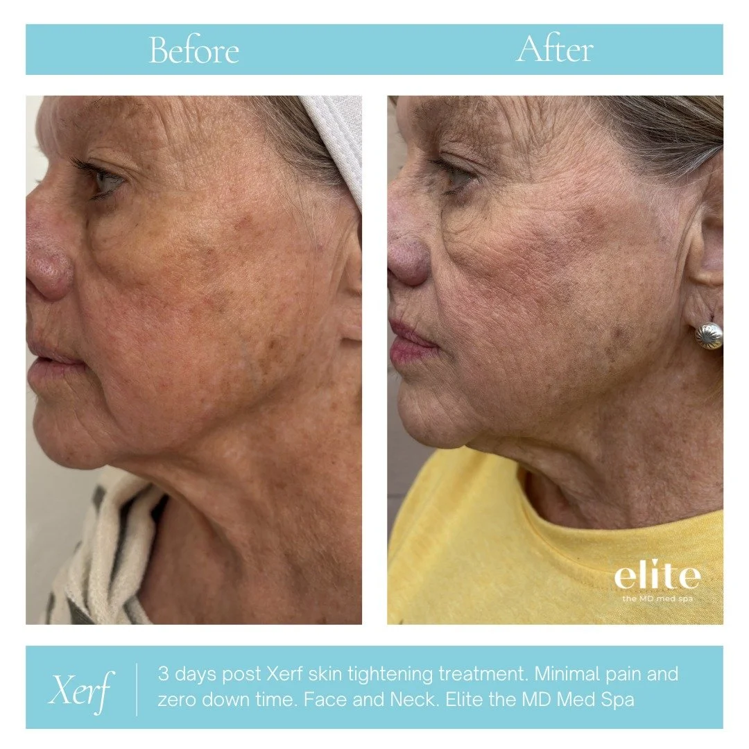 Real results after just one XERF treatment ✨

One of our patients is already seeing a noticeable improvement in her marionette lines&mdash;those lines that form around the mouth as we age.

After her first treatment, they appear softer, less deep, an