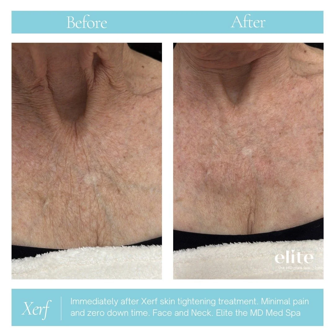 Your chest tells your age too&hellip; but XERF is changing that. ✨

These before + after results were taken immediately after just ONE XERF treatment on the chest area &mdash; with visibly smoother skin, fewer wrinkles, tighter texture, and a more yo