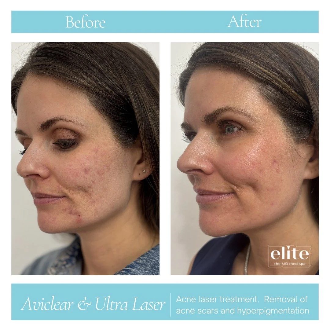 Casey&rsquo;s journey is a reminder that acne treatment doesn&rsquo;t stop with just clearing breakouts.

Her before photo was taken prior to starting treatment with the AviClear laser, when active acne, inflammation, and discoloration were still aff