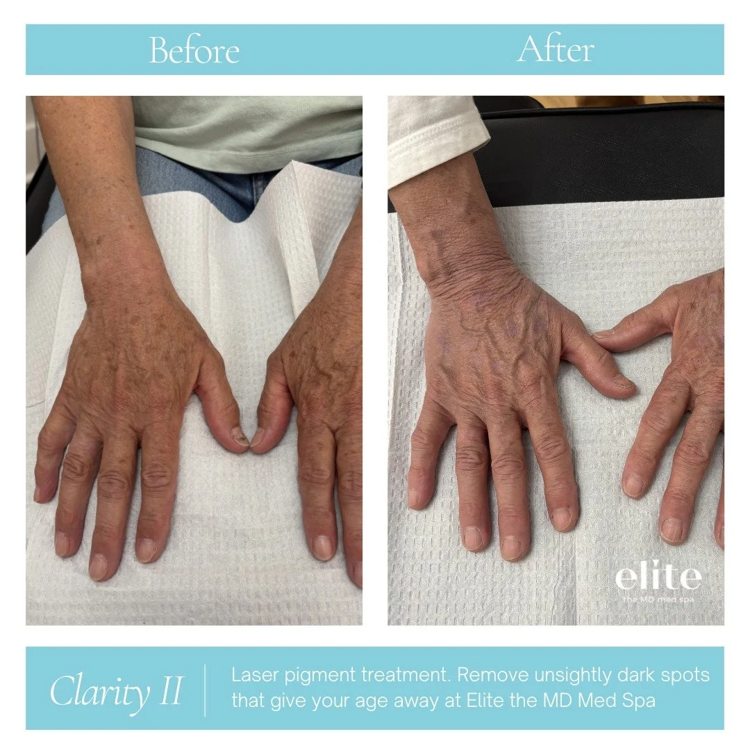 Your hands are one of the first places to show signs of aging and sun damage. ☀️

These before and after results show the power of our Clarity II laser pigment treatment. We targeted unwanted sun spots and discoloration to dramatically brighten and r