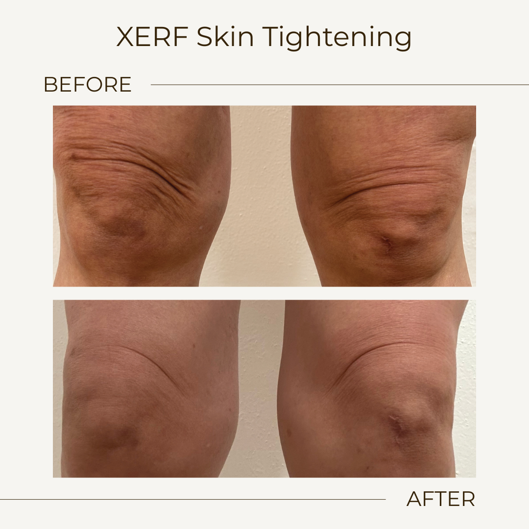 xerf Knees.png