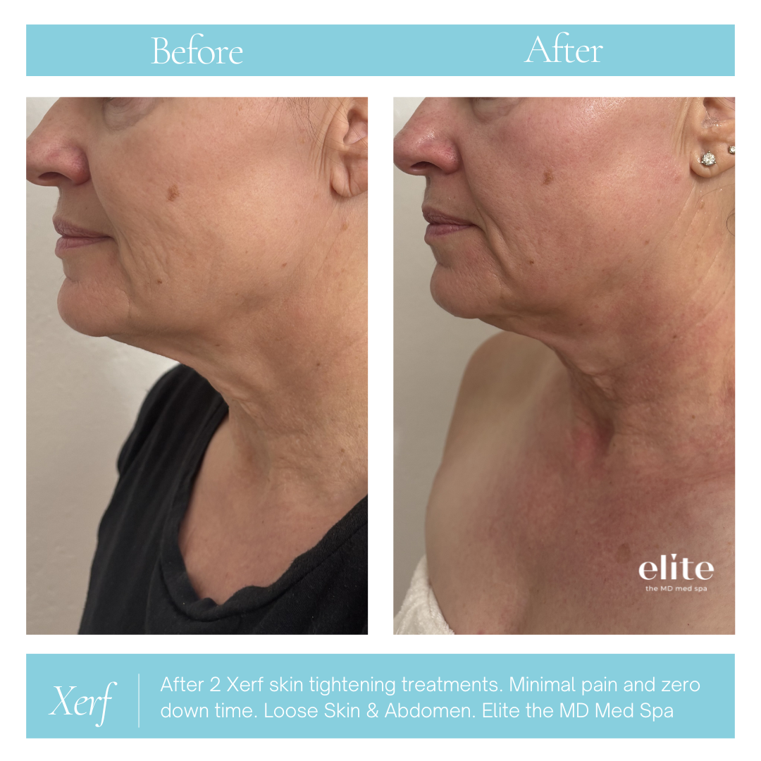 Neck&face after.png