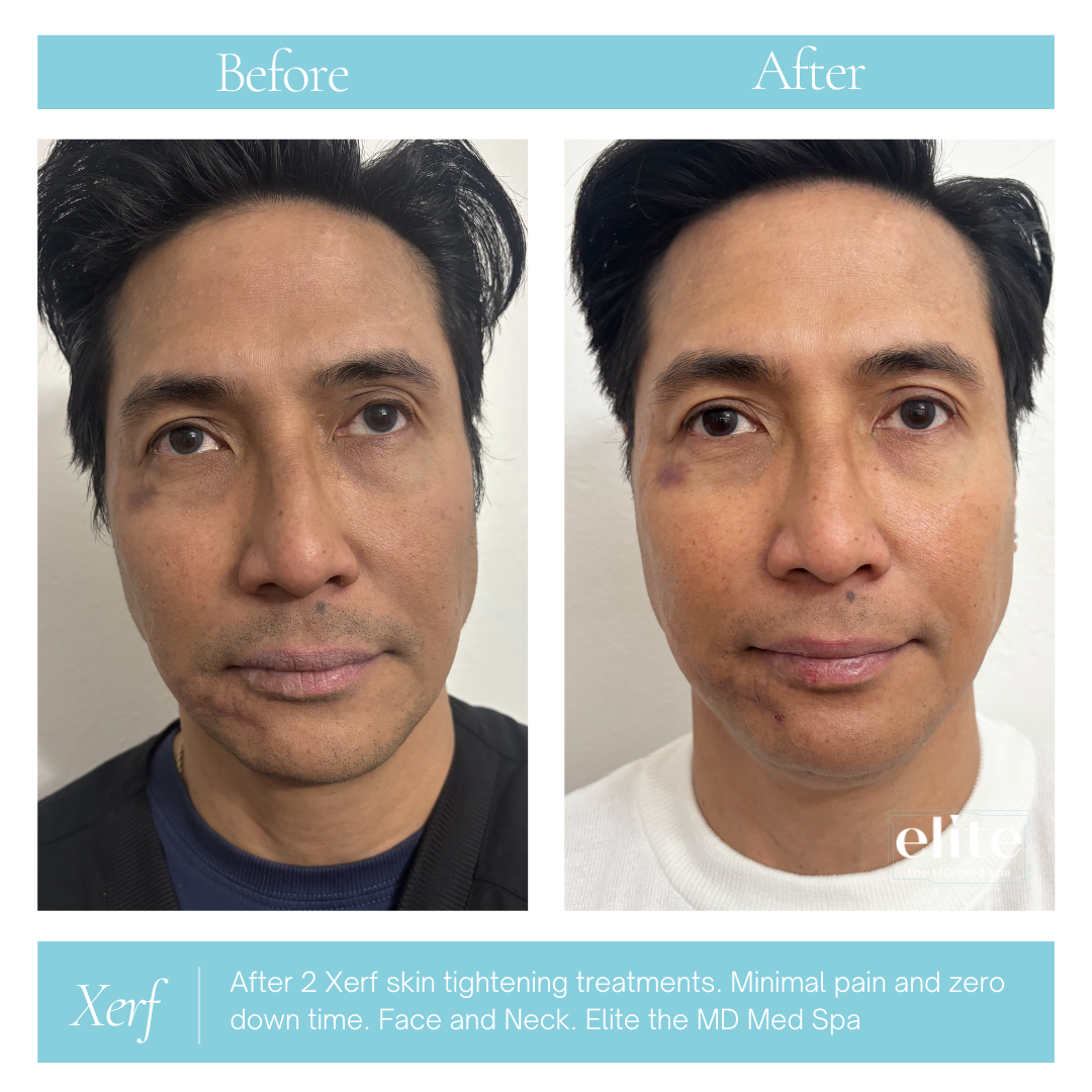 Xerf Male Before and After.png