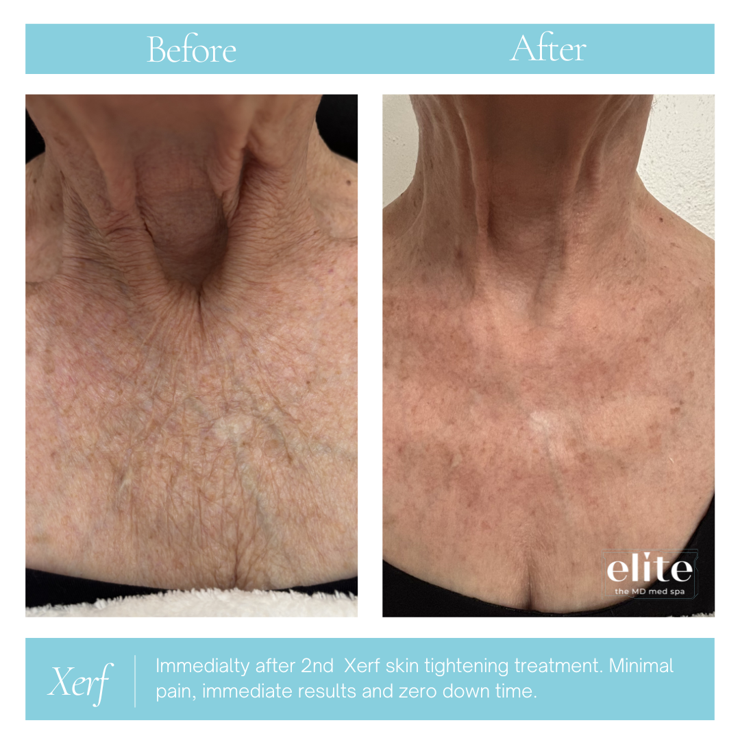 Xerf before and after-Gately Chest.png