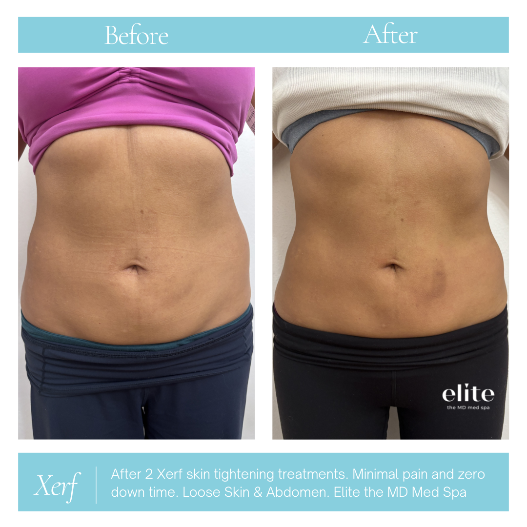 abdomen_xerf_before_after_EliteMD.png