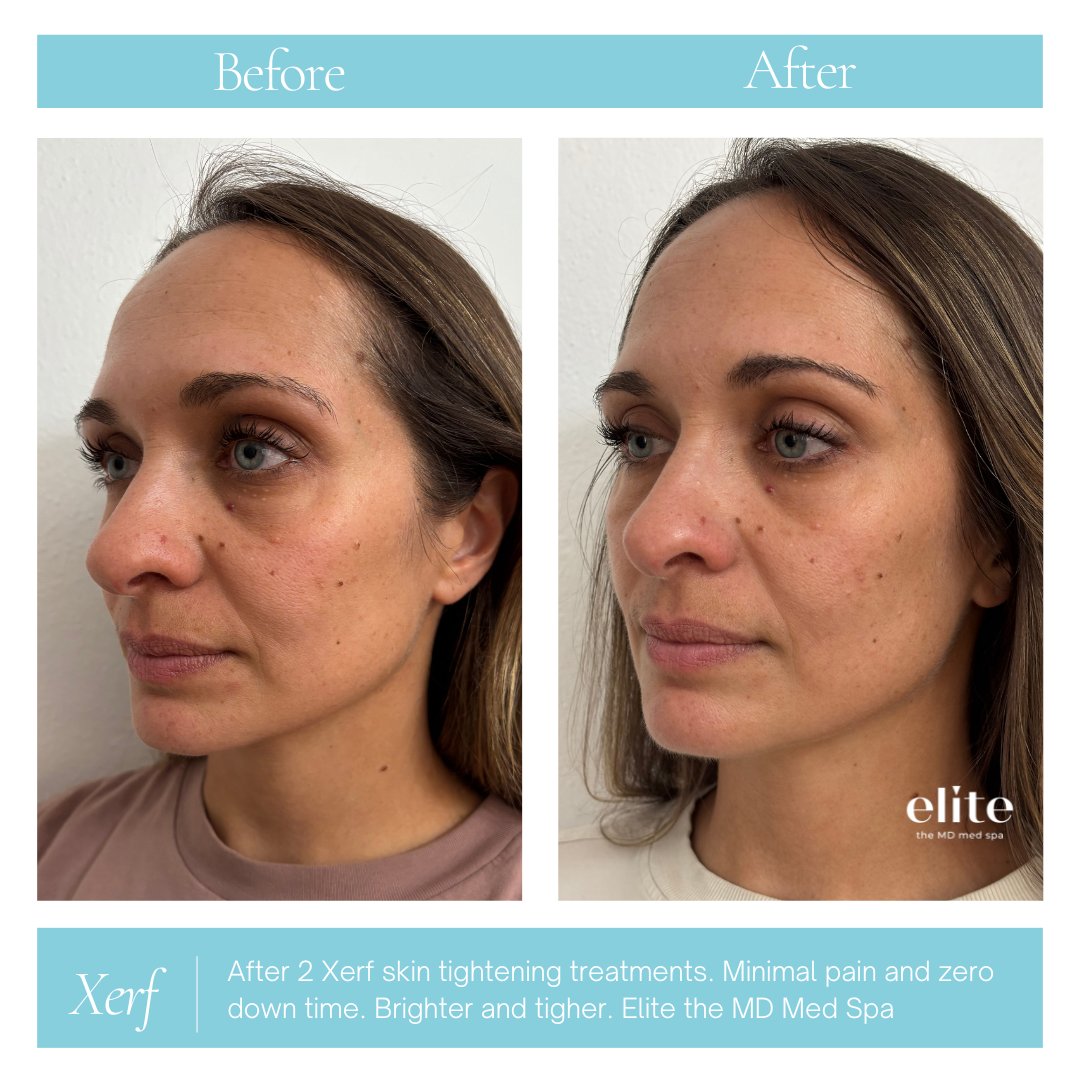 XERF Before and after - Brighter.png