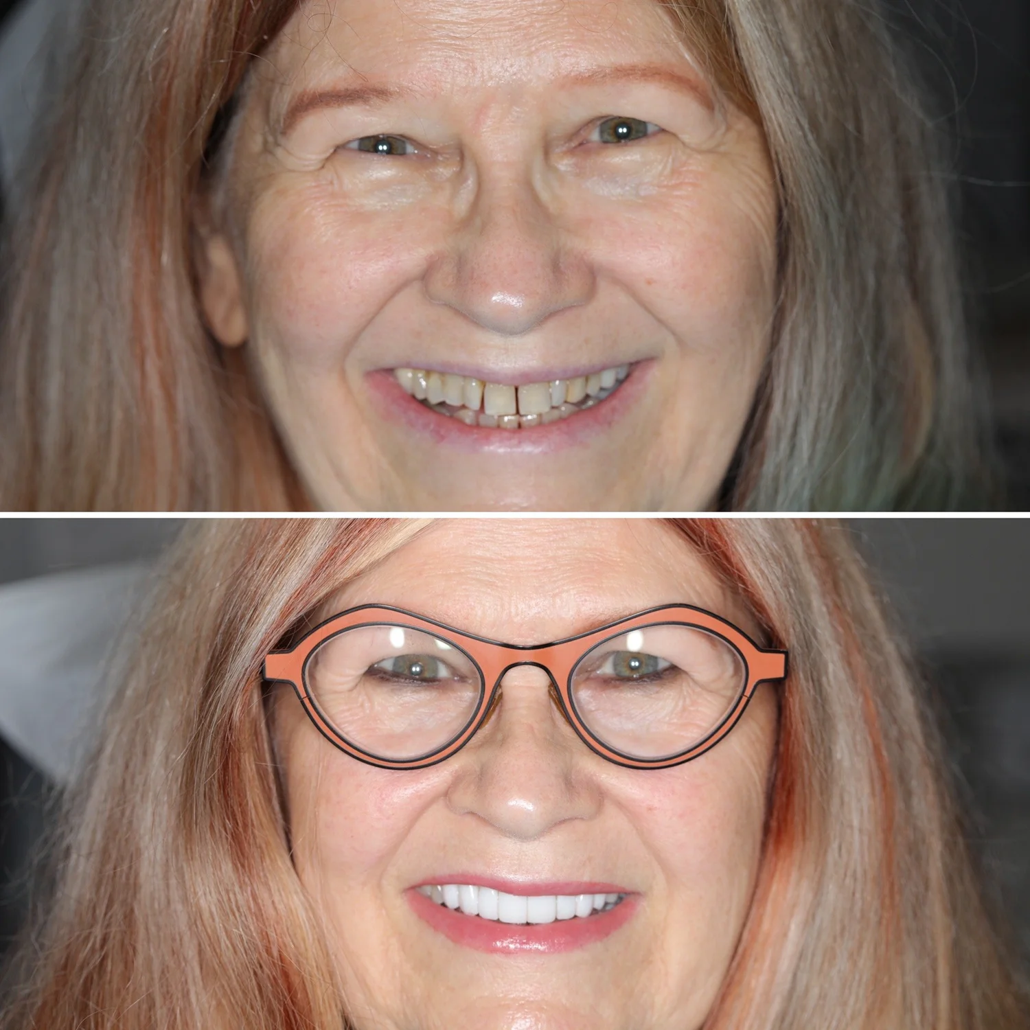 Case Gallery — Highland West Dental Care