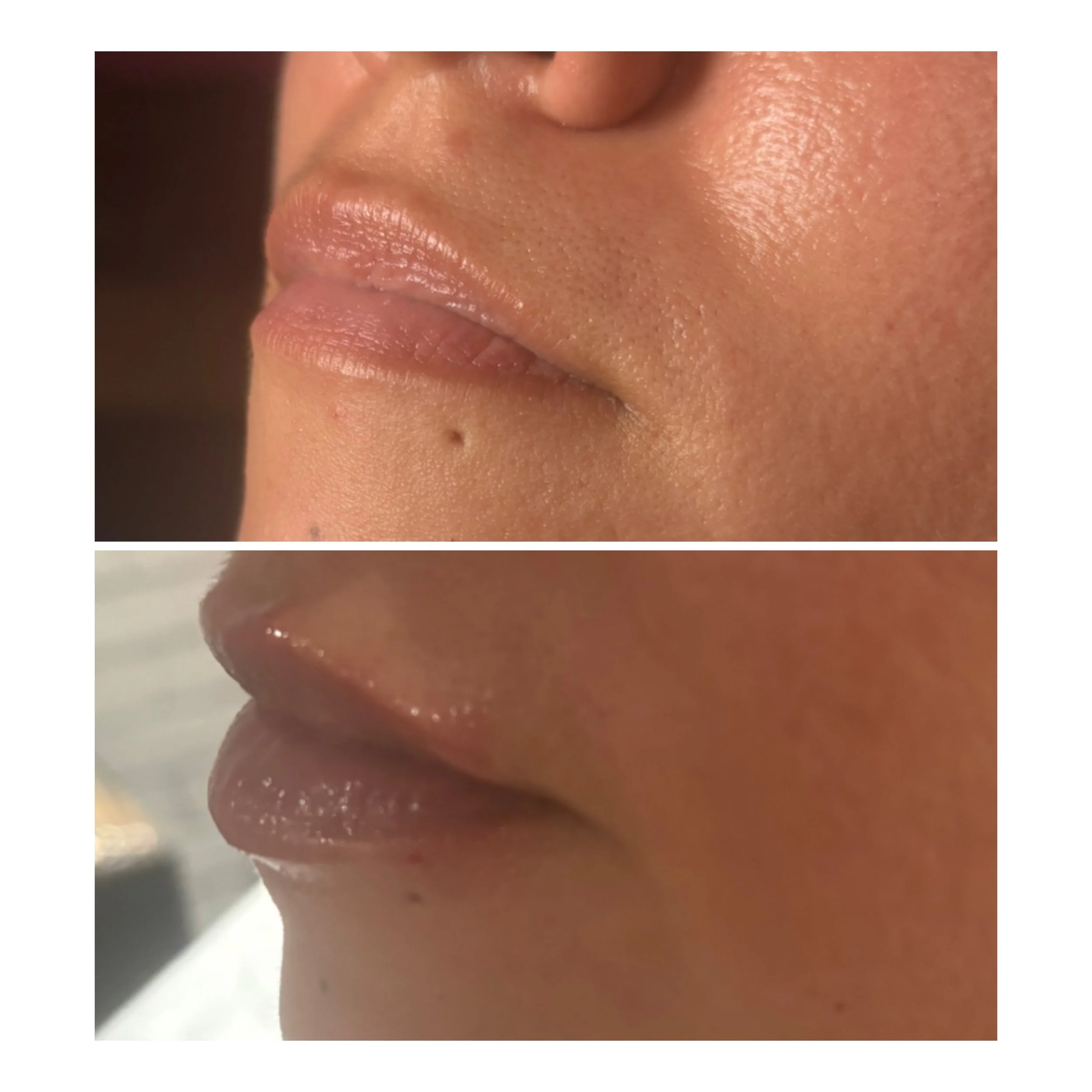 1/2 a vial of lip filler