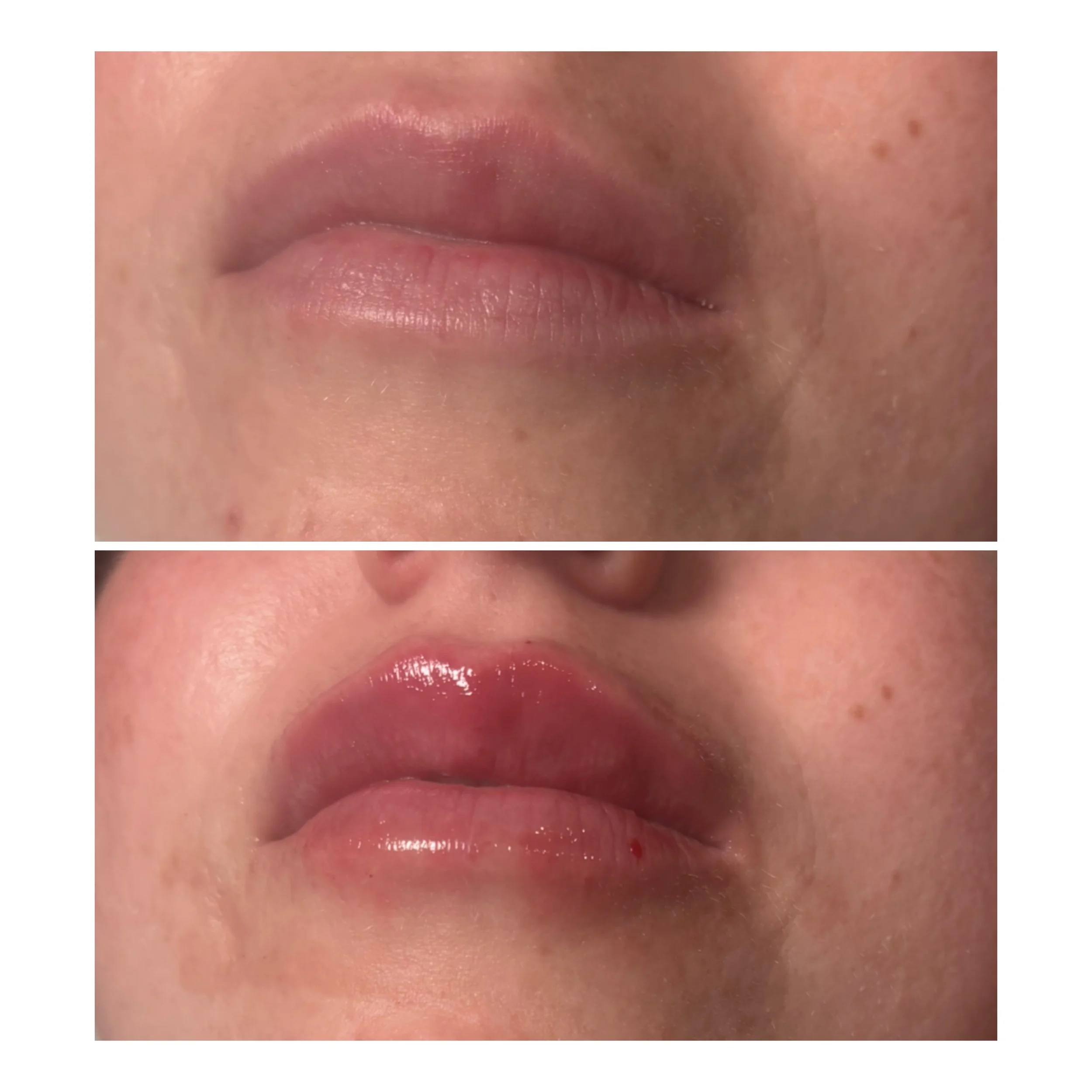 1/2 vial of lip filler