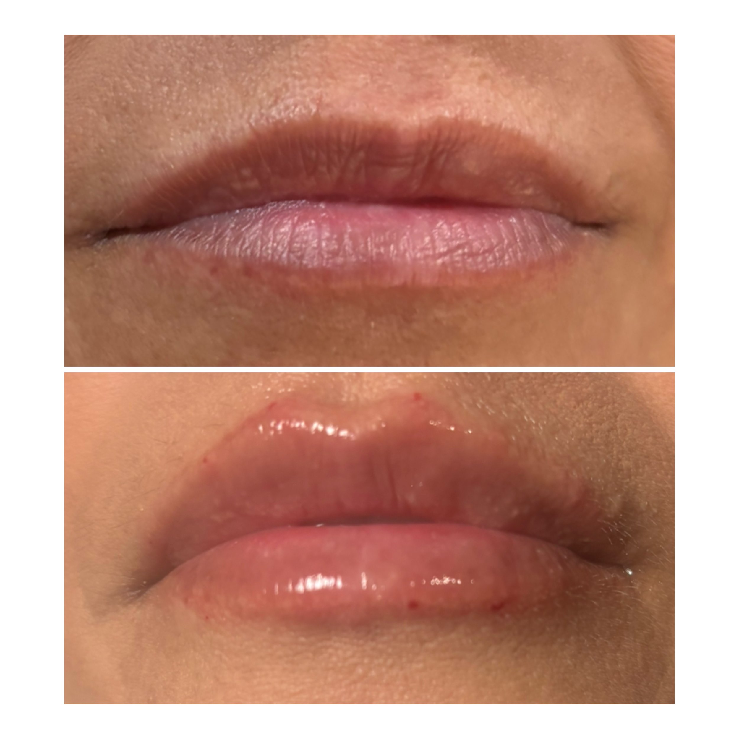 1/2 a vial of lip filler