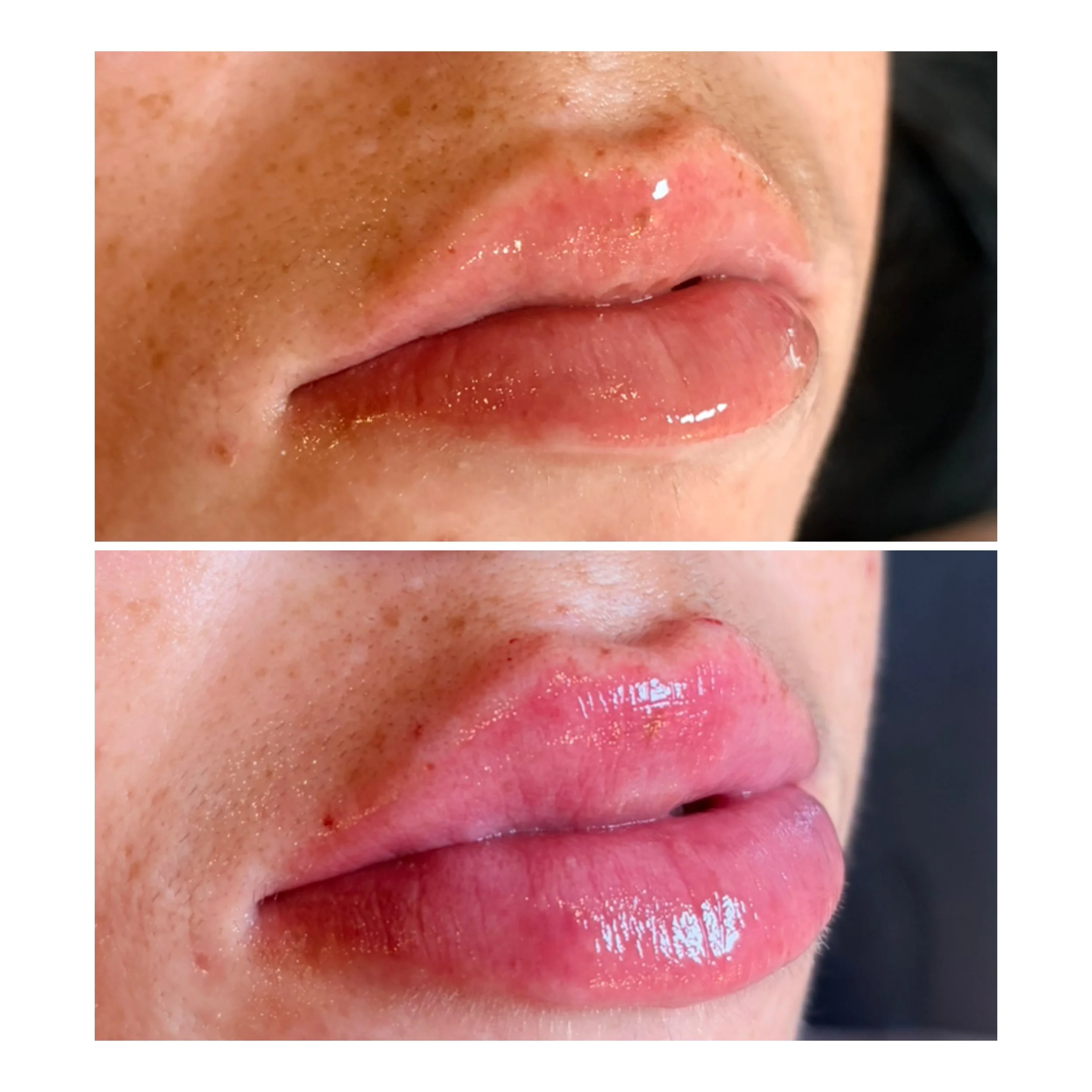 Lip Filler