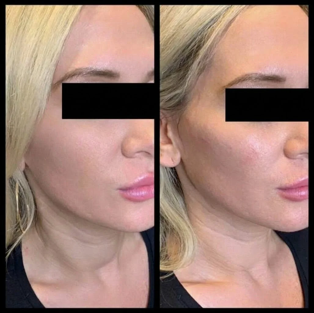 Cheek Filler