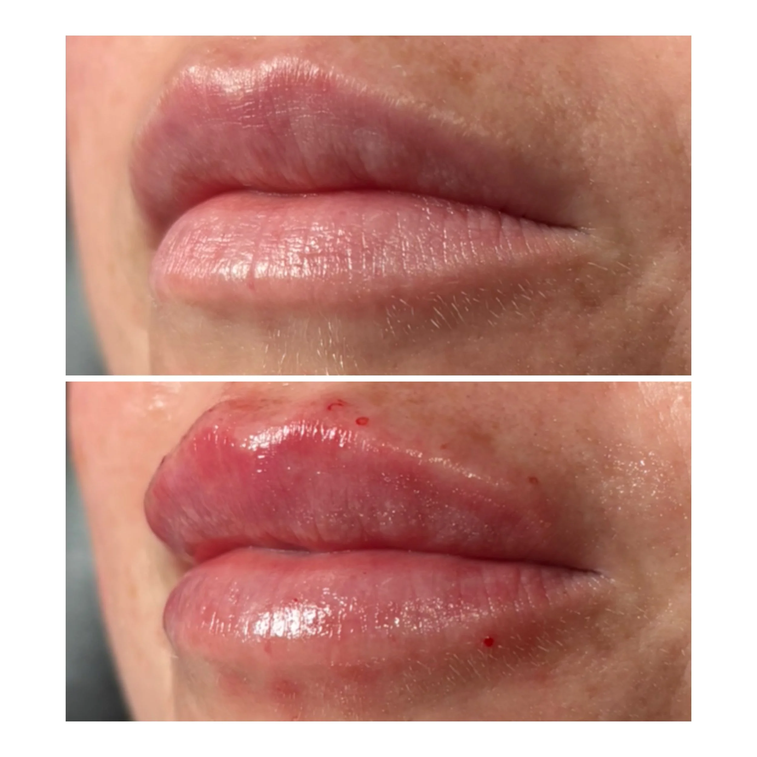 1/2 a vial of lip filler