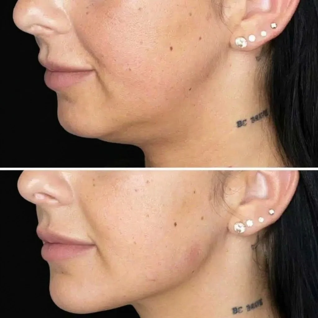 Jaw Filler