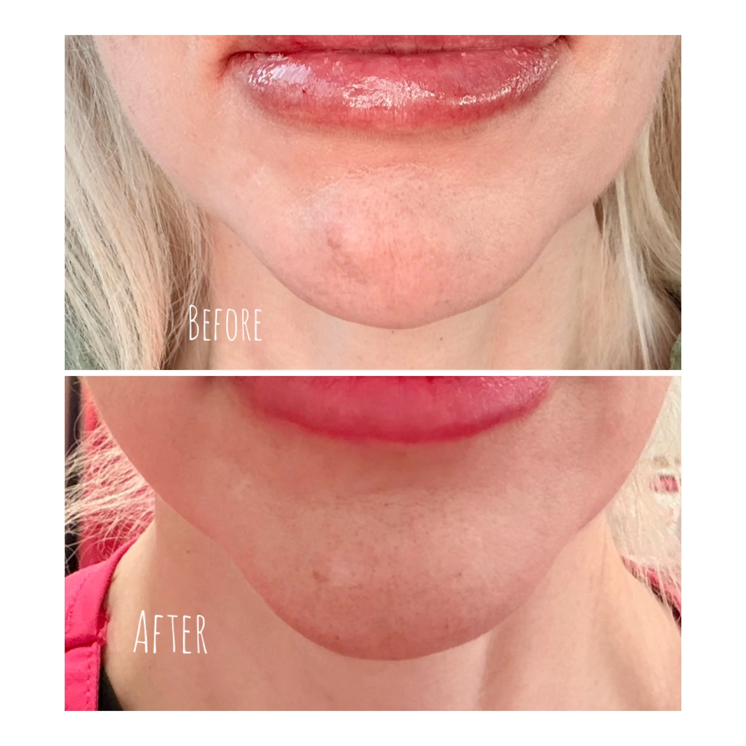 Chin Filler