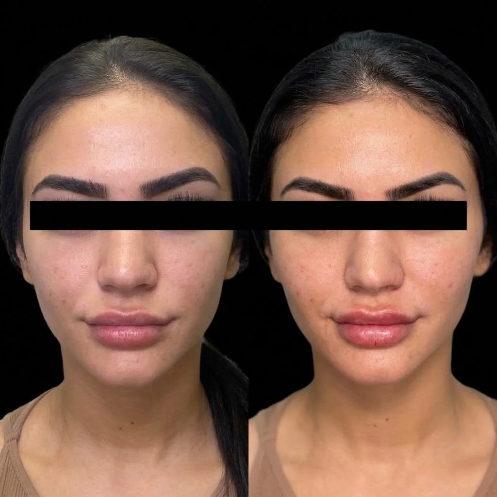 Cheek Filler