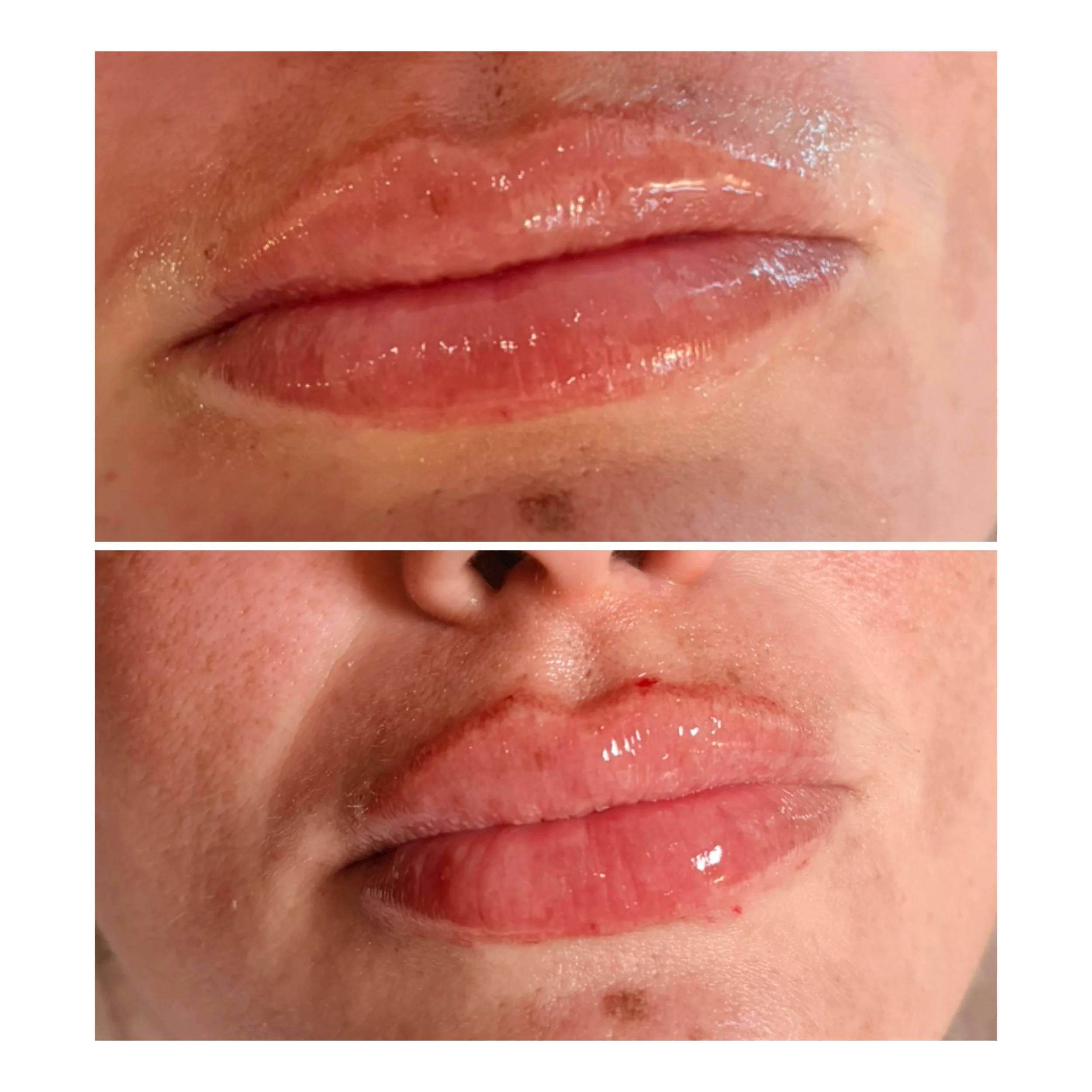 Lip Filler