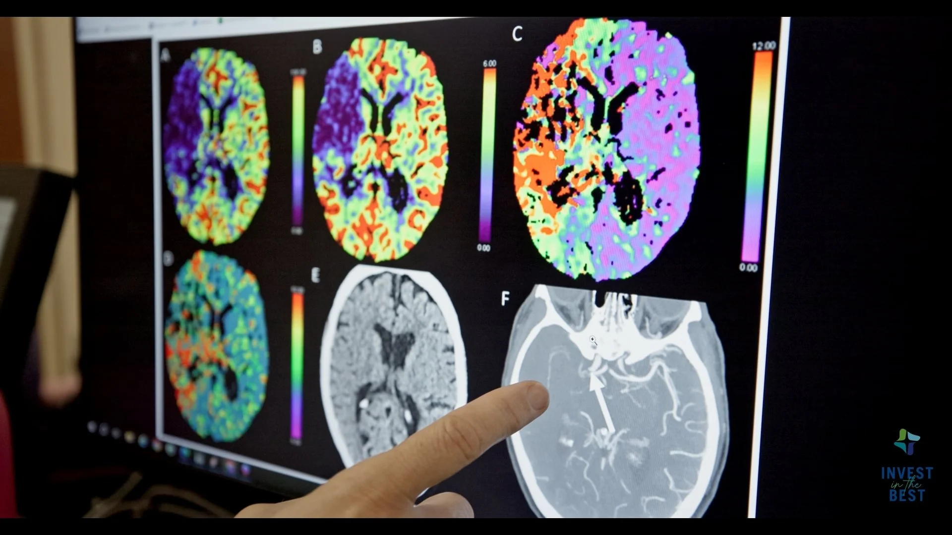 CHI Memorial Hospital - Invest in the Best Campaign - Neurology