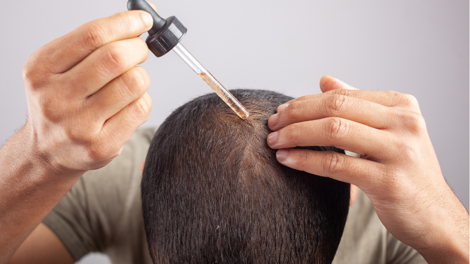 An image of a man applying a serum to his head to prevent hair loss.