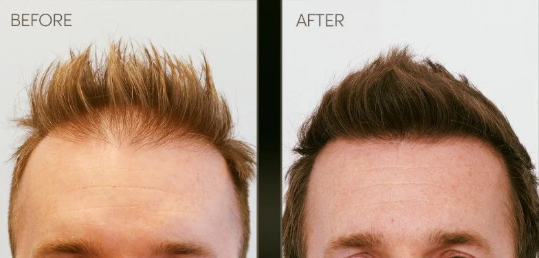 Hairline Transplant Before and After Results