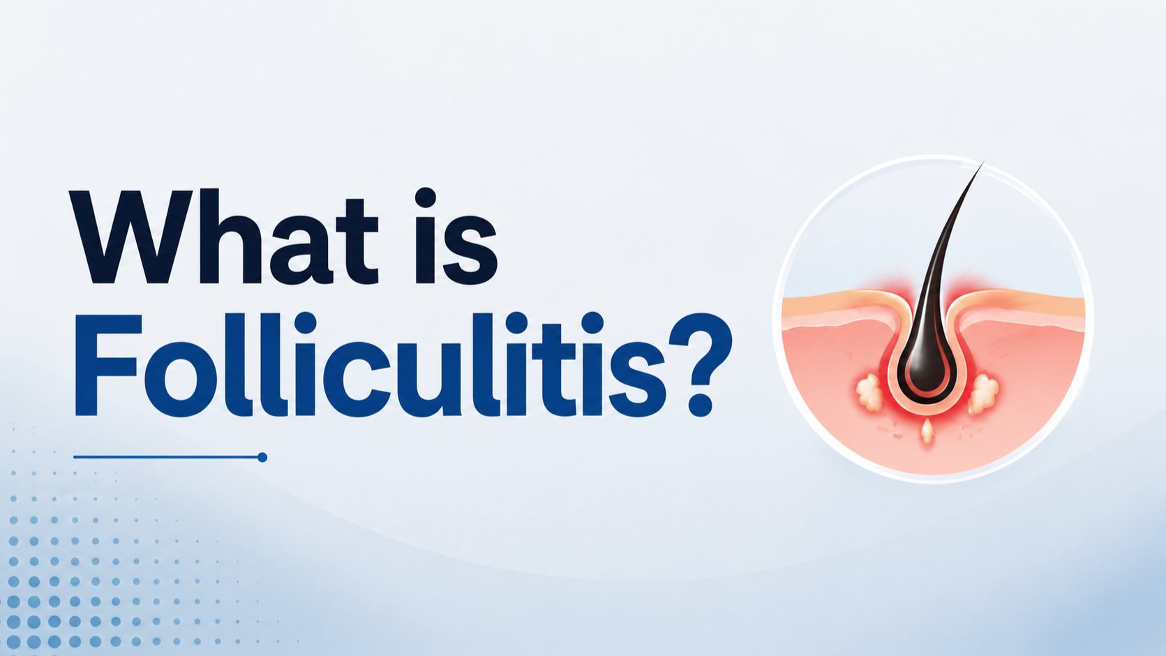 What Is Folliculitis? Scalp Infection &amp; Hair Transplants