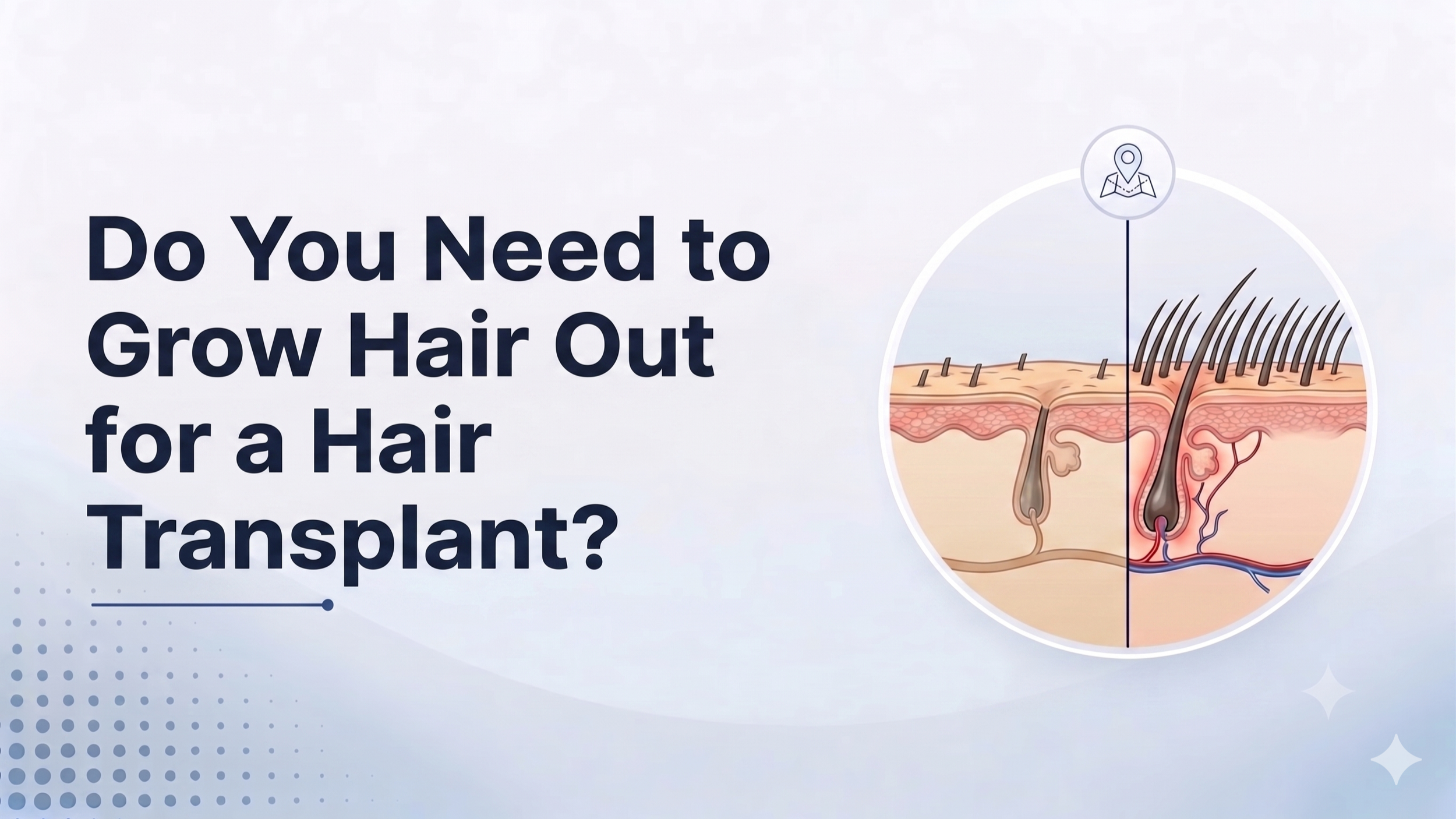 Do You Need to Grow Hair Out for a Hair Transplant?
