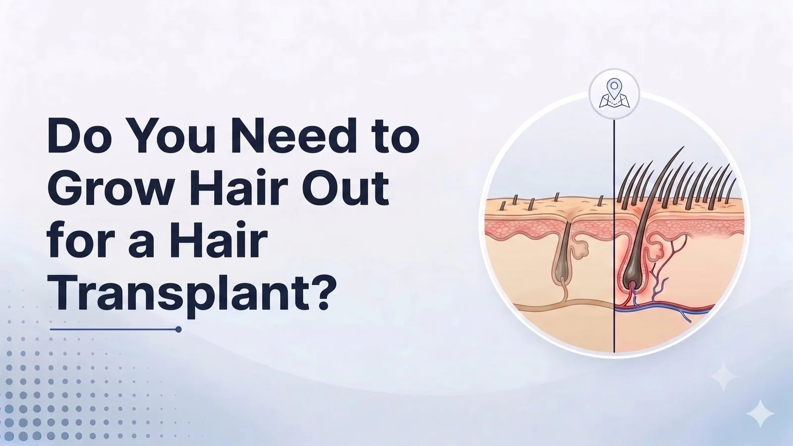 Do You Need to Grow Hair Out for a Hair Transplant?
