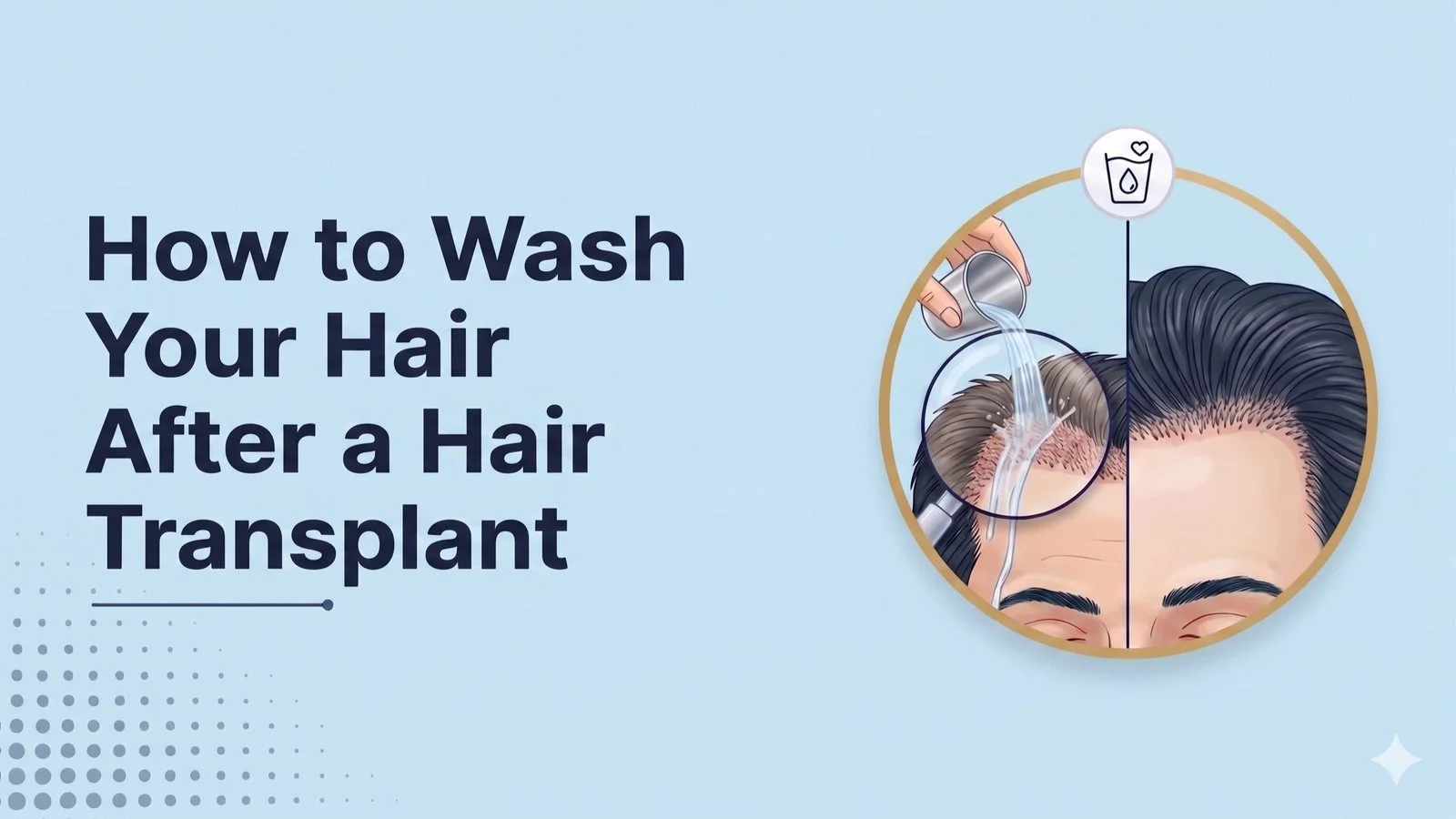 How to Wash Your Hair After a Hair Transplant