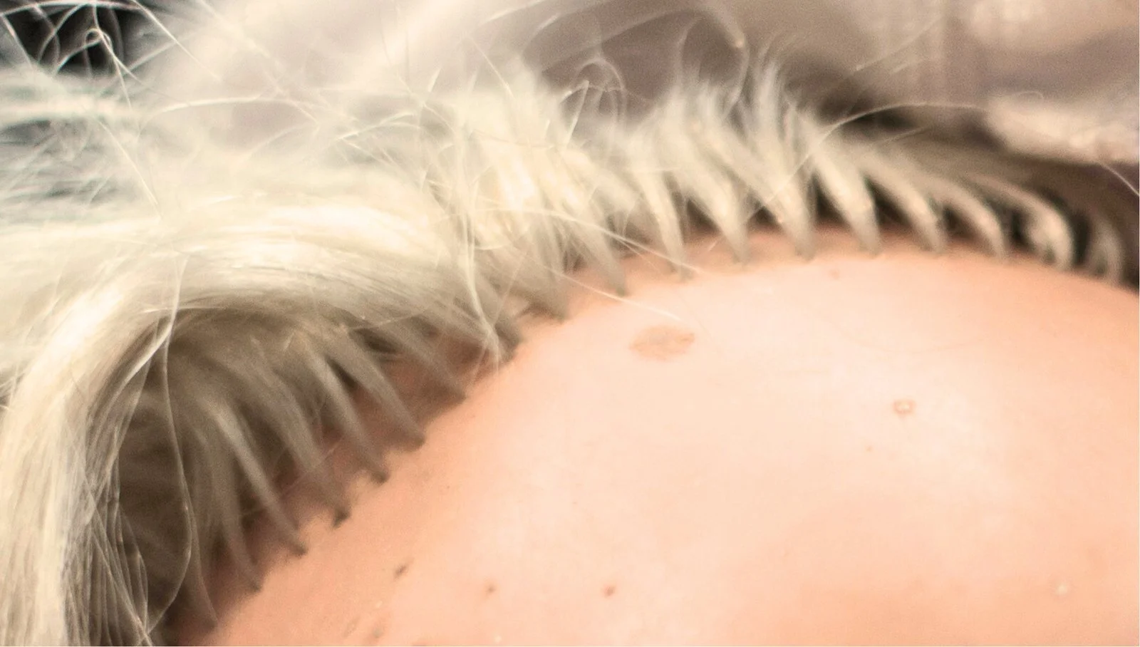 Understanding Hair Plugs: Are They Still Relevant in Hair Restoration?