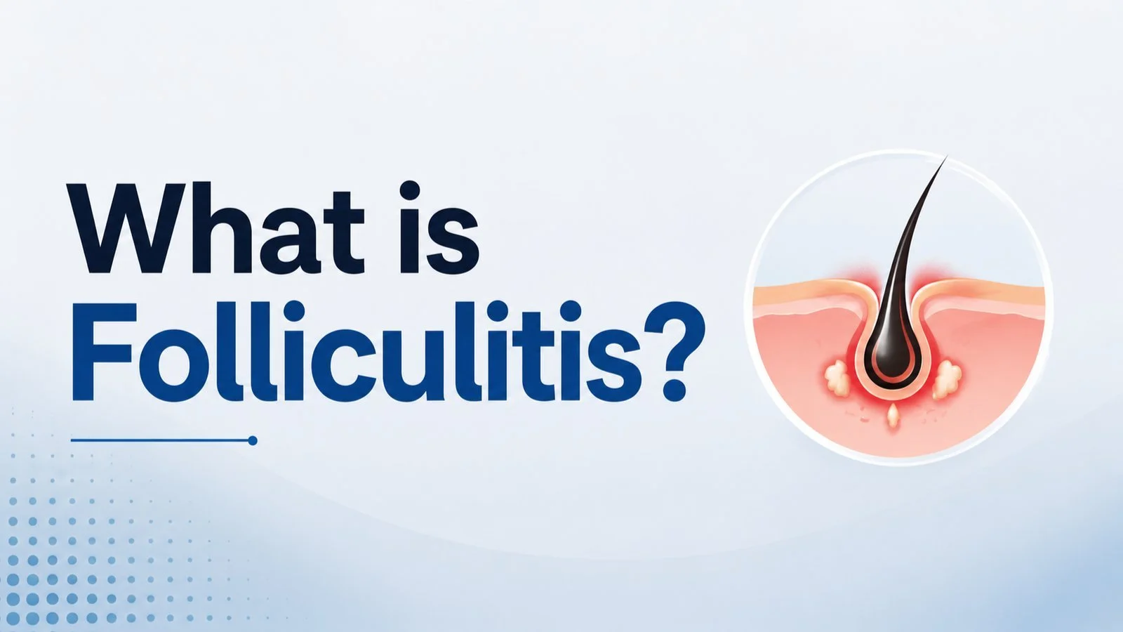 What Is Folliculitis? Scalp Infection &amp; Hair Transplants