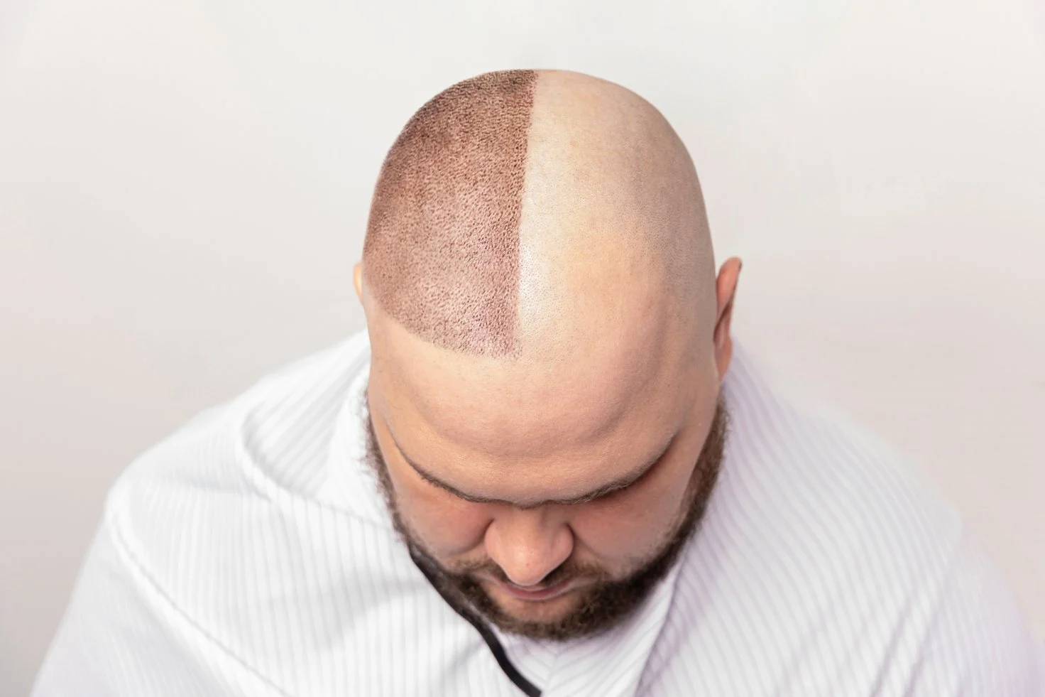 What is Scalp Micropigmentation (SMP)?