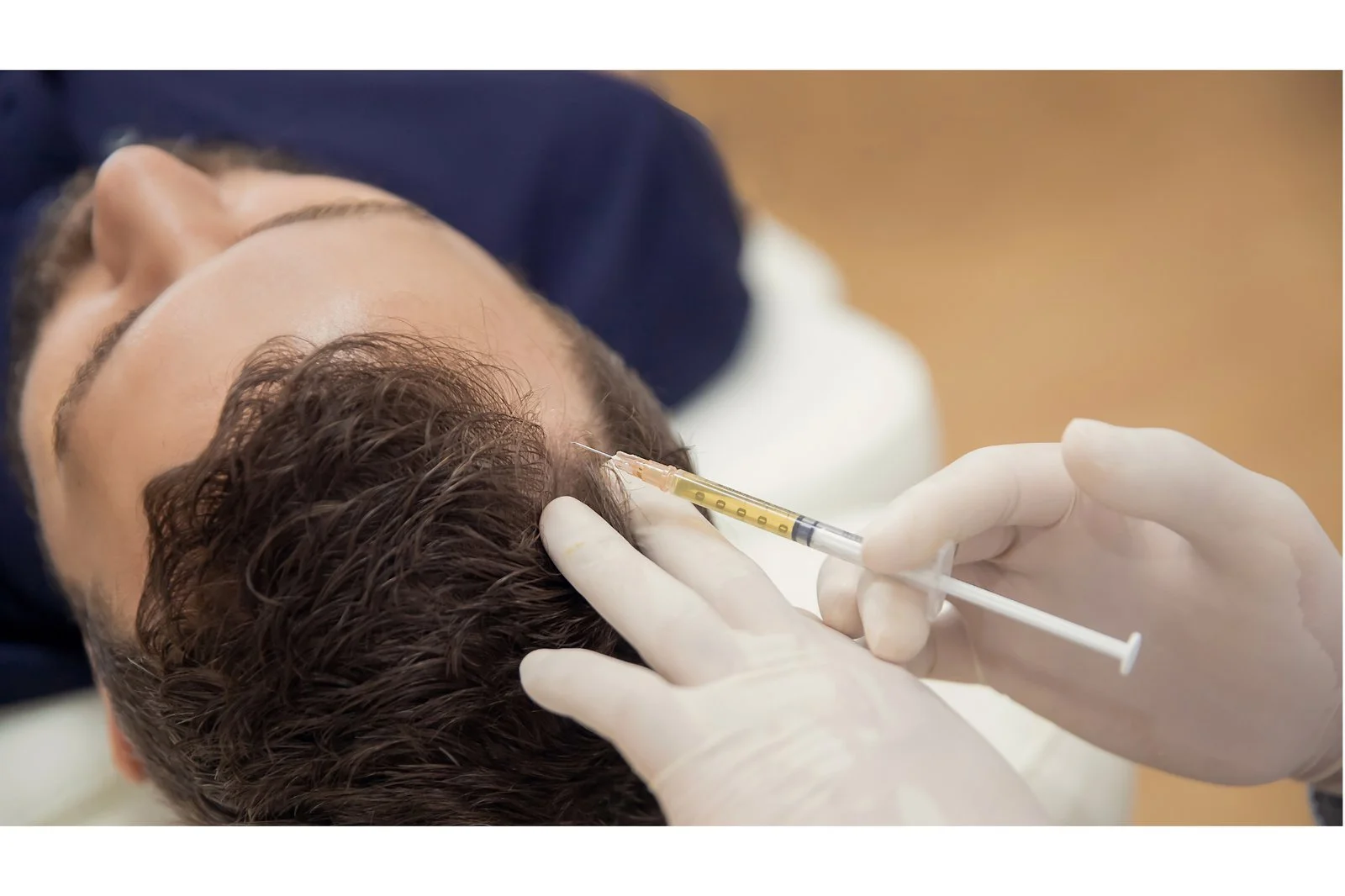 Exploring Alternative Hair Loss Solutions: What You Need to Know About PRP, Exosomes, ACell and Stem Cell Treatments for Hair Loss