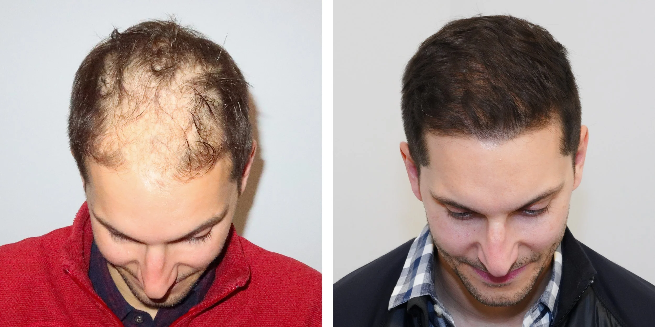 Do Hair Transplants Really Work? Proven Results &amp; What to Expect
